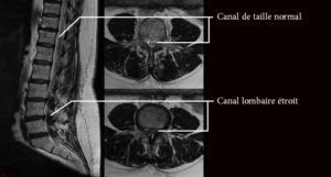 Le canal lombaire étroit et la sténose foraminale Dr PENNES NICE
