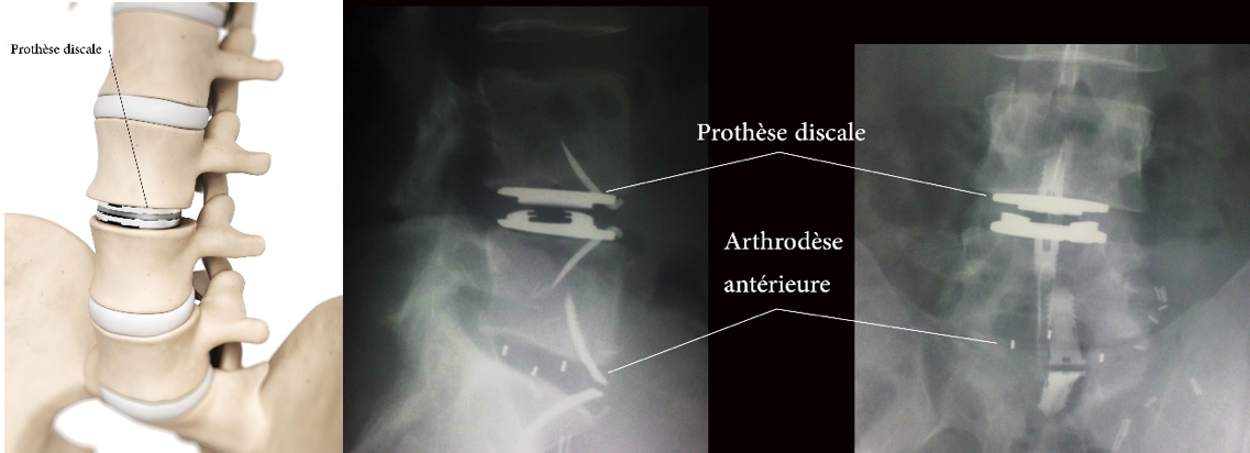 arthrodèse et la prothèse par voie antérieure ou latérale