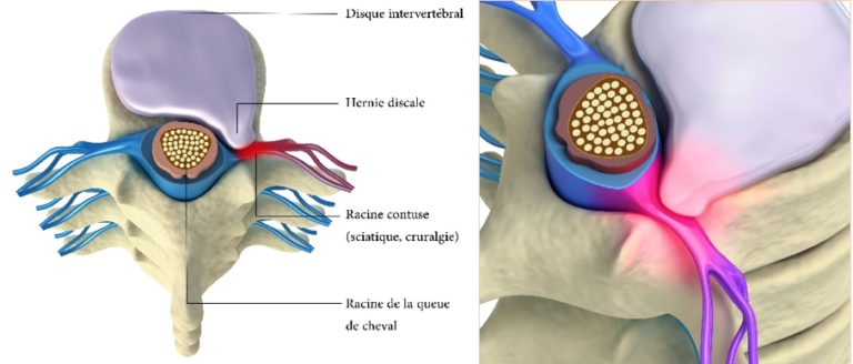 La Hernie Discale Lombaire Docteur Florent Pennes Neurochirurgien Nice