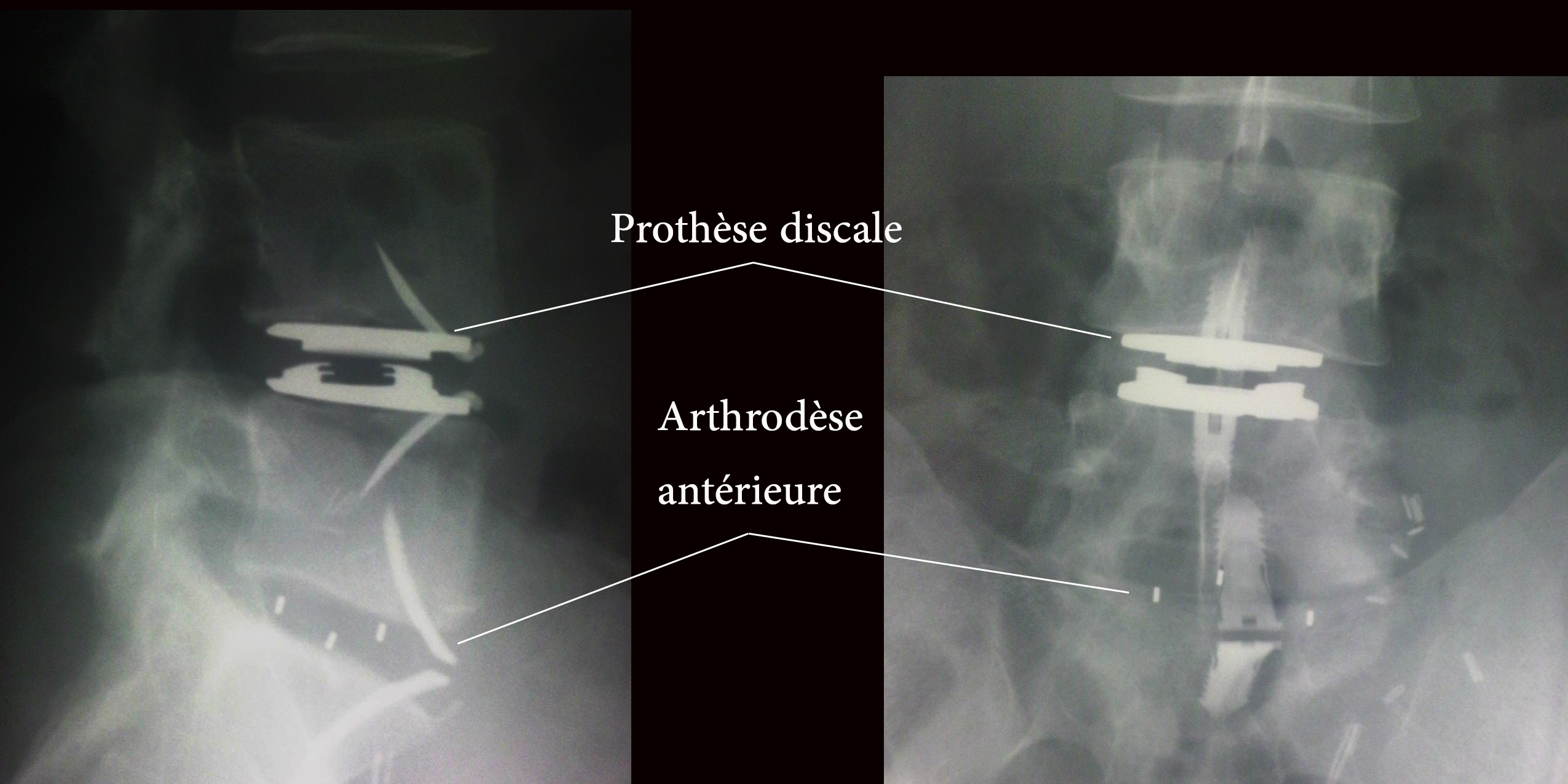 prothèse discale chirurgie du dos