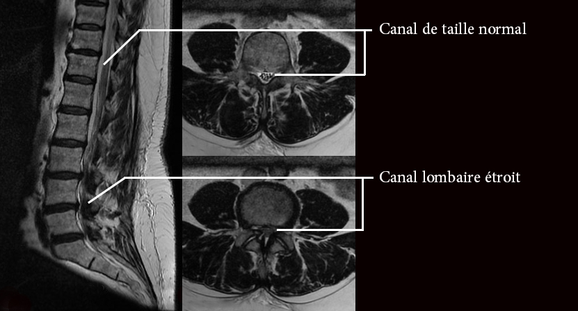 Le canal lombaire étroit (CLE) et la sténose foraminale.