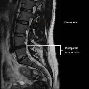 La discopathie dégénérative lombaire et ses conséquences