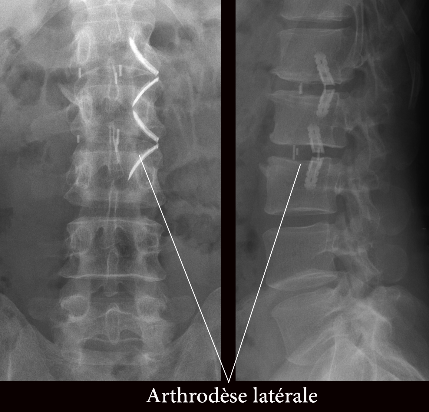 arthrodèse latérale