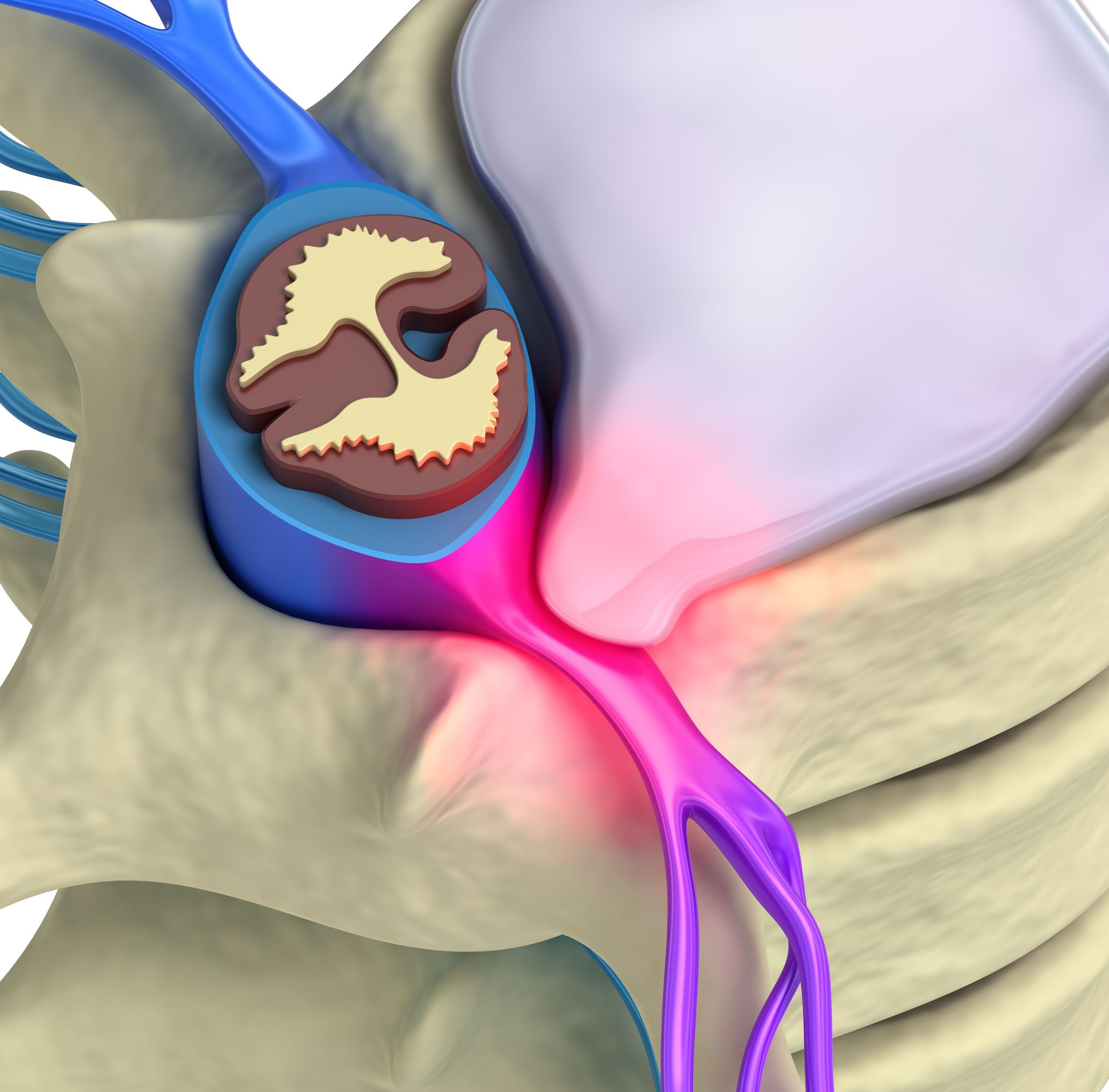 La hernie discale cervicale et l'uncodiscarthrose - Dr. Florent PENNES