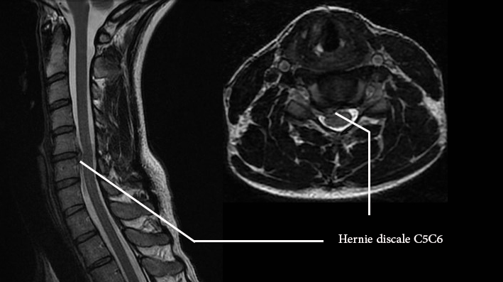 La hernie discale cervicale et l’uncodiscarthrose