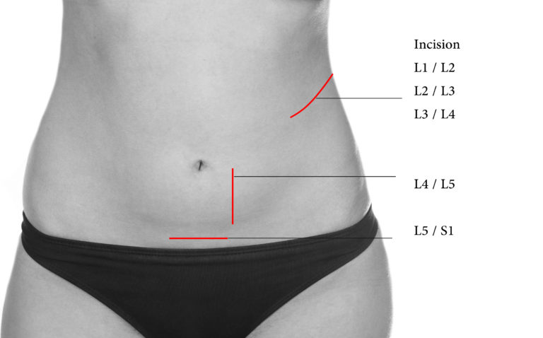 incision ALIF OLIF DLIF - Chirurgie du Dos - Dr Florent Pennes
