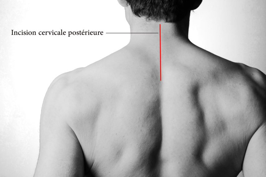 Le traitement chirurgical du canal cervical étroit Neurochirurgie Nice