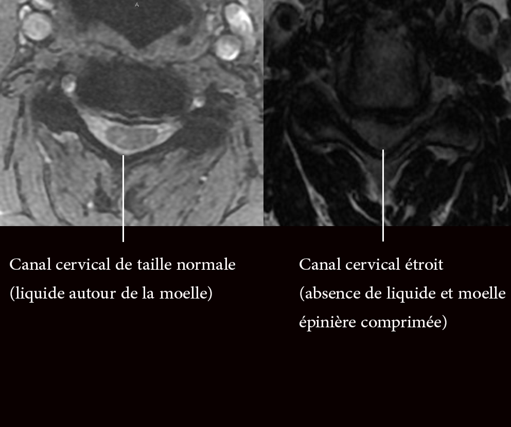Le canal cervical étroit (CCE) et la myélopathie cervicarthrosique.