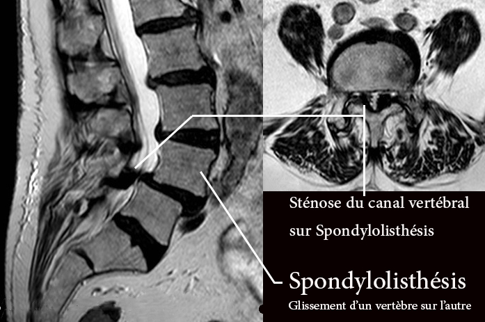 Le spondylolisthésis 